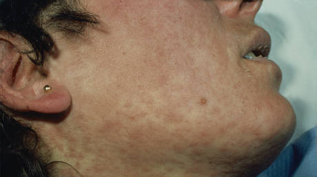FILE PHOTO: Measles rash on a patient.