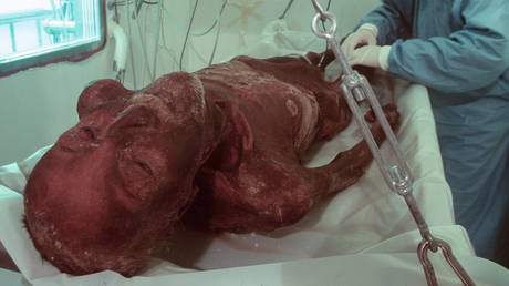 FILE PHOTO: Otzi the Iceman seen during an examination, Bolzano, Italy, 27 March 1998.